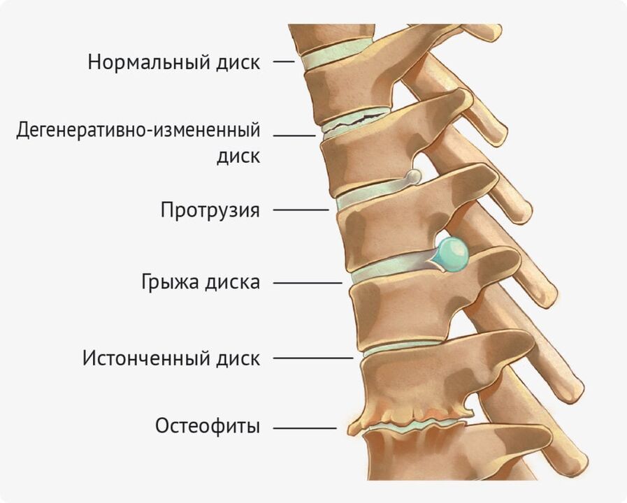 Deformity of the disc for lumbar osteochondosis