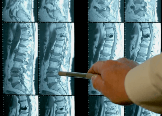 Variety of osteochondrosis in the spine