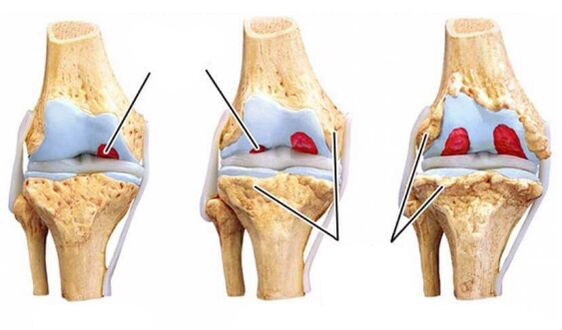 grades-arthrosis