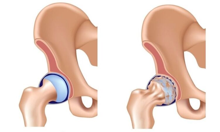 Healthy and joint joint with arthrosis