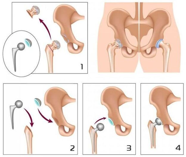 Replacement of a painful joint with a prosthesis