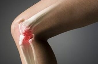 The arthrosis of the knee joint is an injury of the cartilage tissue