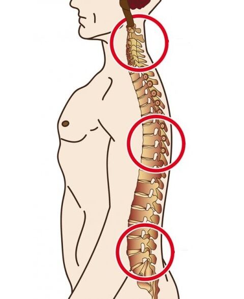 Spinal departments in which osteochondosis occurs