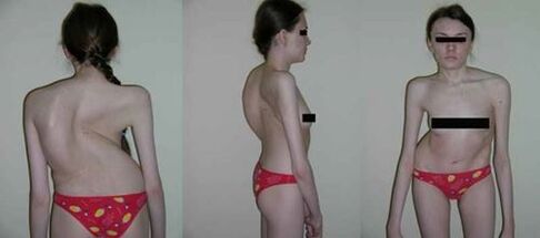 curvature of the spine as a consequence of osteochondosis