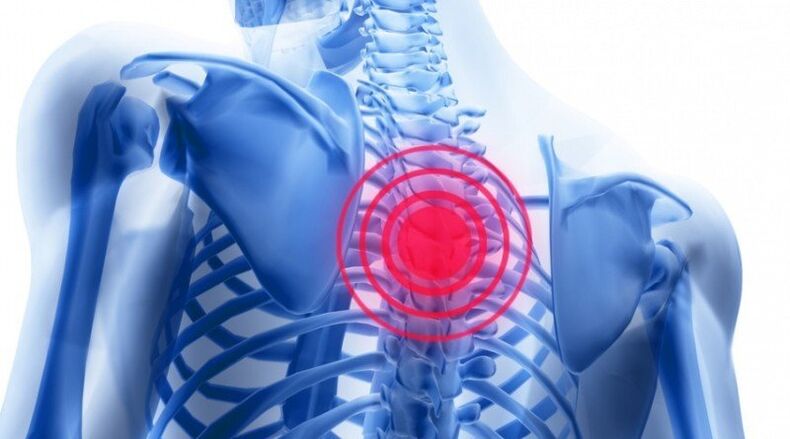 Back pain may be due to a herniated disc