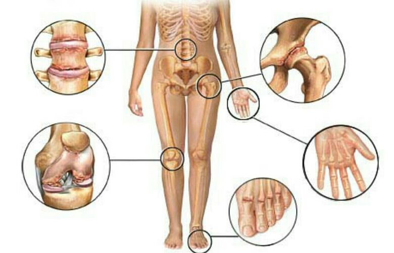 types and degrees of osteoarthritis
