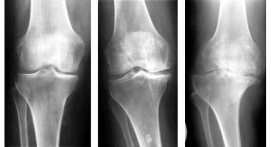 A mandatory diagnostic measure when identifying knee arthrosis is an x-ray