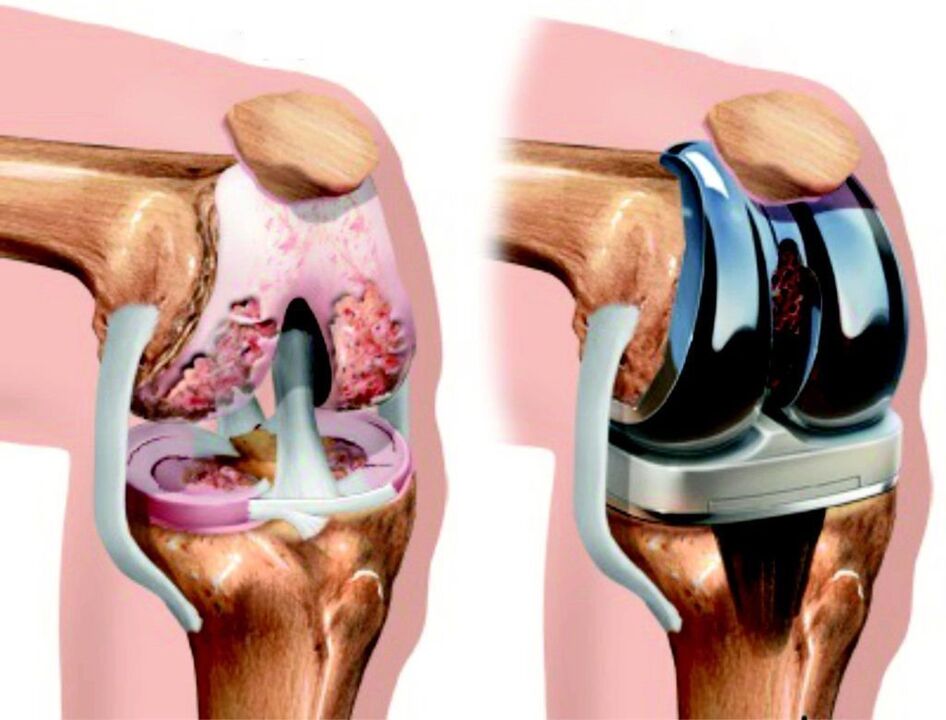 In case of total damage to the knee joint caused by arthrosis, it is possible to restore it using endoprosthetics